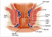 Biểu hiện của bệnh trĩ